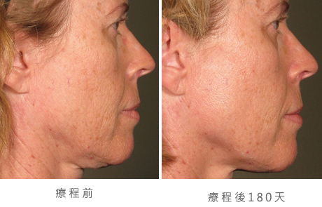 before_after_ultherapy_results_full-face15
