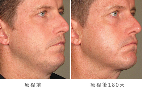 before_after_ultherapy_results_full-face16