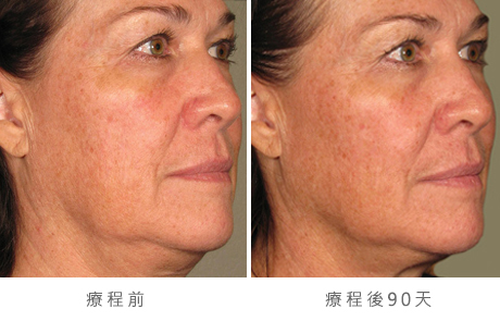 before_after_ultherapy_results_full-face20