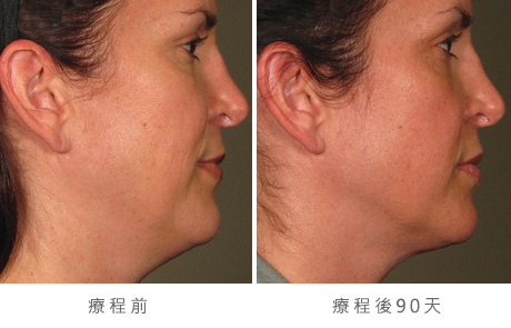 before_after_ultherapy_results_full-face6