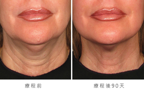 before_after_ultherapy_results_neck3