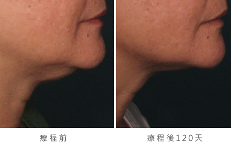 before_after_ultherapy_results_under-chin1