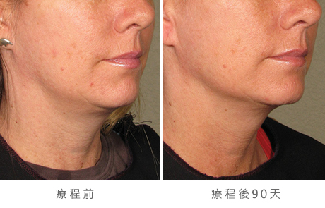 before_after_ultherapy_results_under-chin11