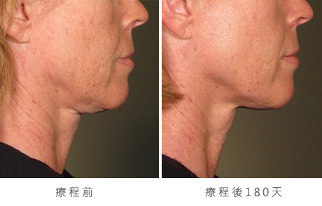 before_after_ultherapy_results_under-chin16