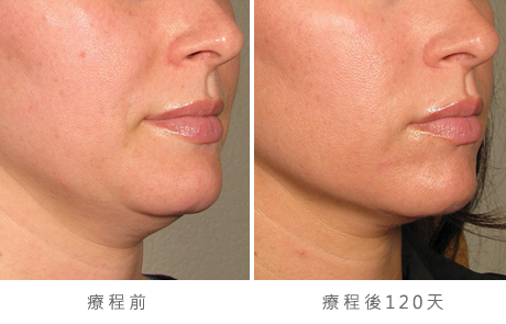 before_after_ultherapy_results_under-chin18
