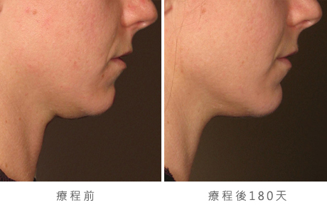 before_after_ultherapy_results_under-chin20