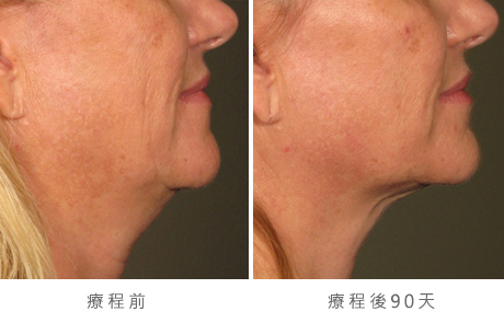 before_after_ultherapy_results_under-chin30