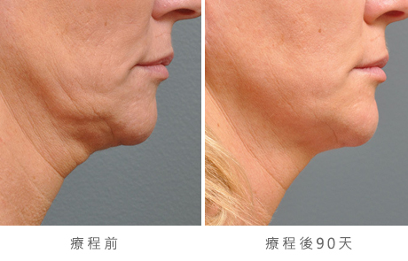 before_after_ultherapy_results_under-chin33