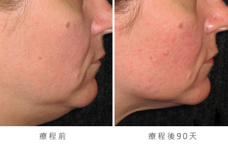 before_after_ultherapy_results_under-chin34