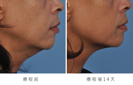 before_after_ultherapy_results_under-chin37