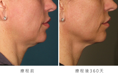 before_after_ultherapy_results_under-chin4