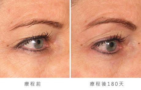 img_template_beforeafter_brow10