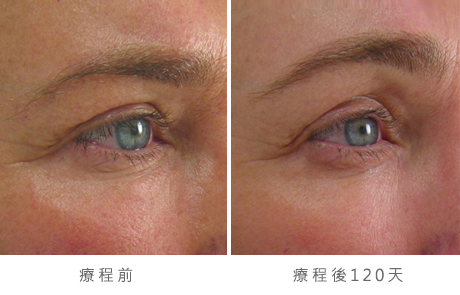 img_template_beforeafter_brow11