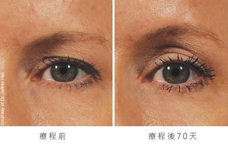 img_template_beforeafter_brow12