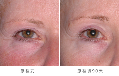 img_template_beforeafter_brow14