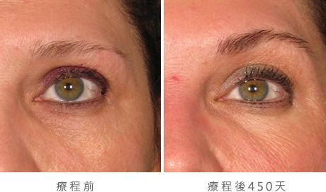 img_template_beforeafter_brow5