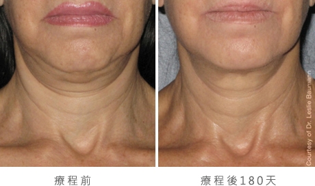ultherapy-0008-0086w_180day_1tx_neck1_gallery