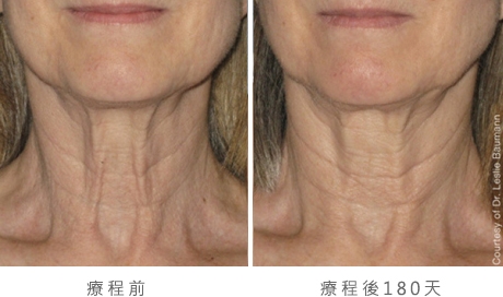 ultherapy-0028-0086w_180day_1tx_neck_gallery