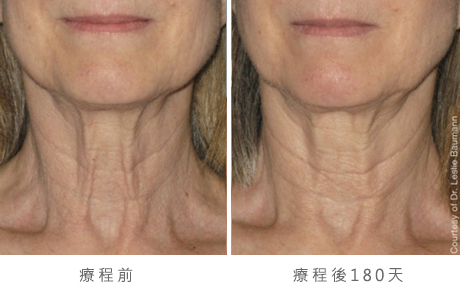 ultherapy-0028-0086w_180day_1tx_neck_gallery