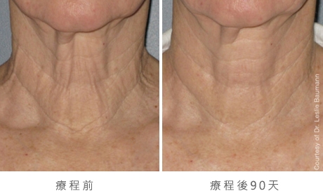 ultherapy-bl0017_90day_1tx_neck_gallery